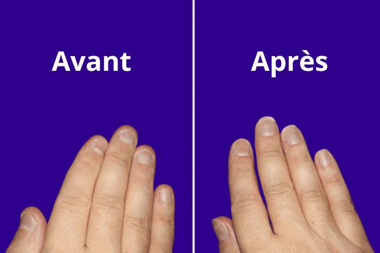 Arrêter l’onychophagie définitivement